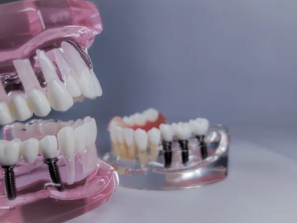 All-on-4 implants procedure