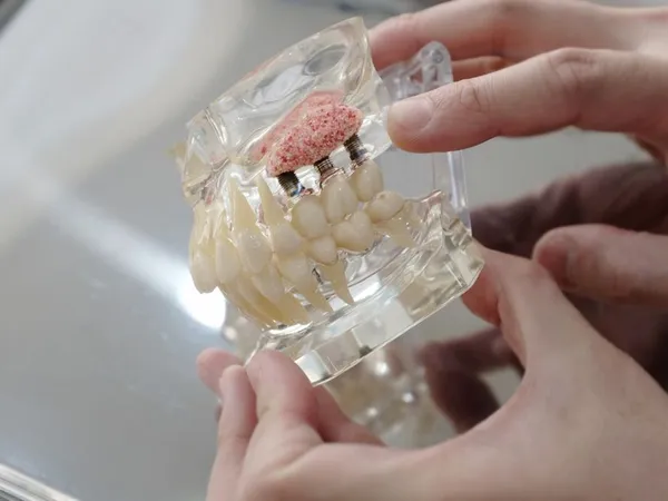 Upper jaw dental implants